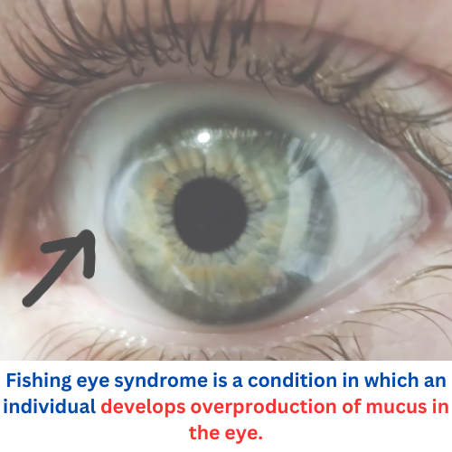 What Is Fishing Eye Syndrome