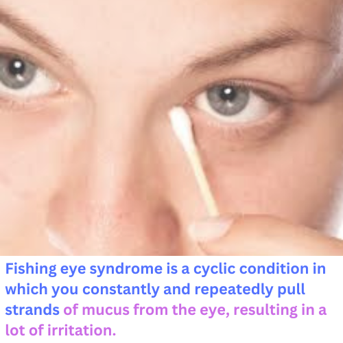 What Is Fishing Eye Syndrome