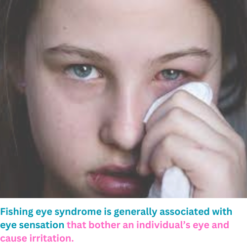 What Is Fishing Eye Syndrome