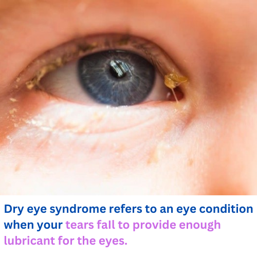 What Is Fishing Eye Syndrome